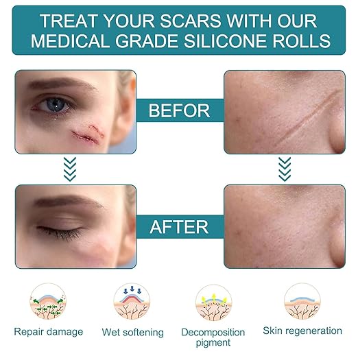Reusable Medical-Grade Silicone Scar Strips
