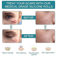 Reusable Medical-Grade Silicone Scar Strips Roll